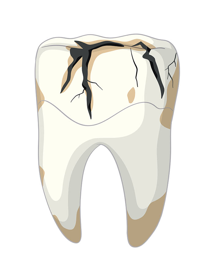 carie dente dental cure sacchi cesano maderno