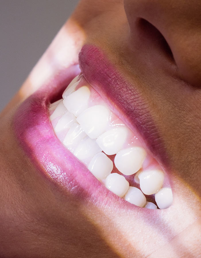 Sbiancamento dentale Dentista Cesano Maderno Seregno Dental Cure Sacchi